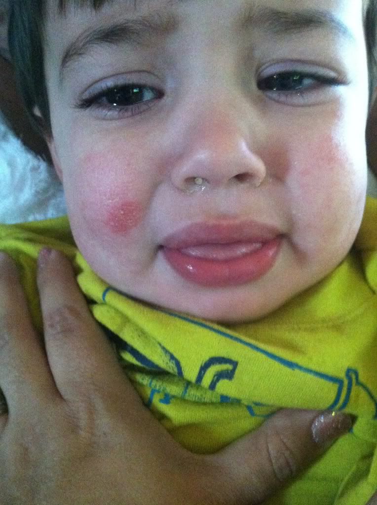 red-blotch-on-face-what-is-this-babycenter